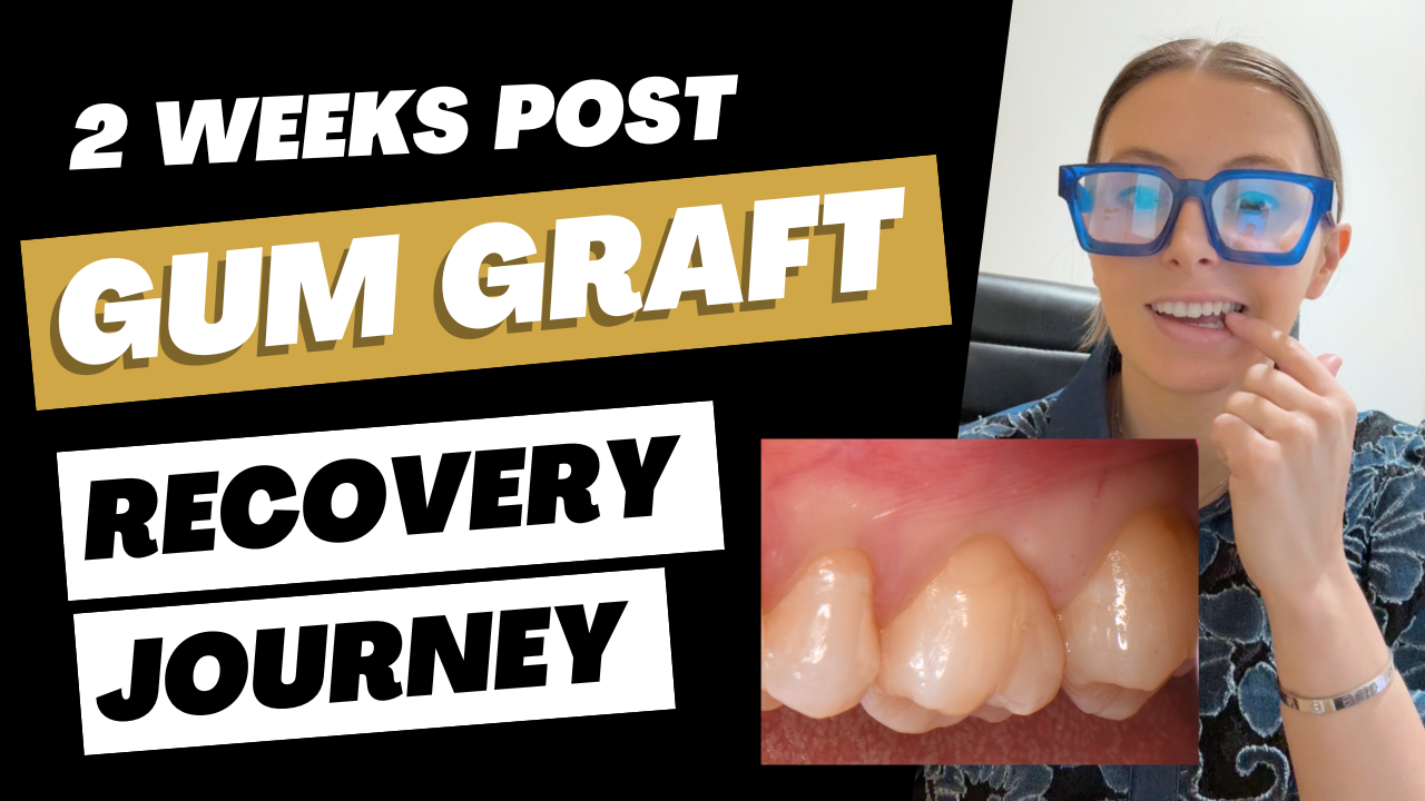 Gum Graft Recovery: 2 Weeks Post Op #periodontist #gumgraft #gumrecession #washingtondc #dentist