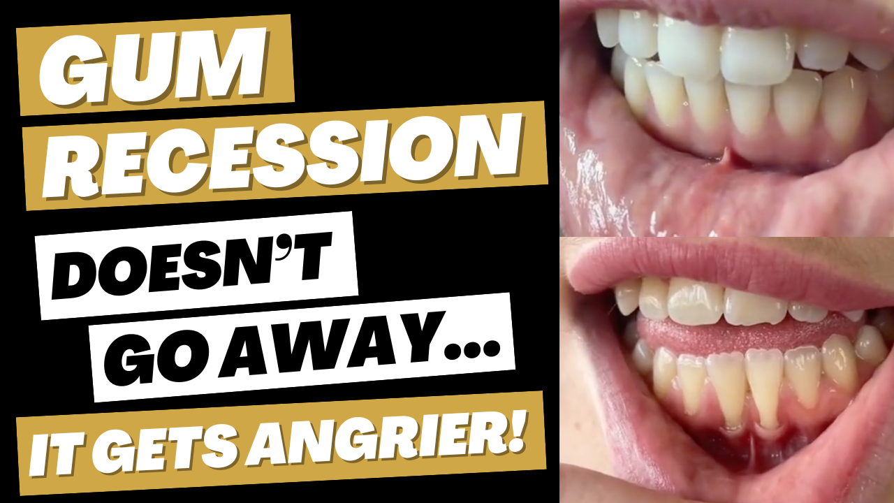 Gum Recession Doesn’t Go Away- it gets ANGRIER! #gumgraft #gumrecession #washingtondc #periodontist