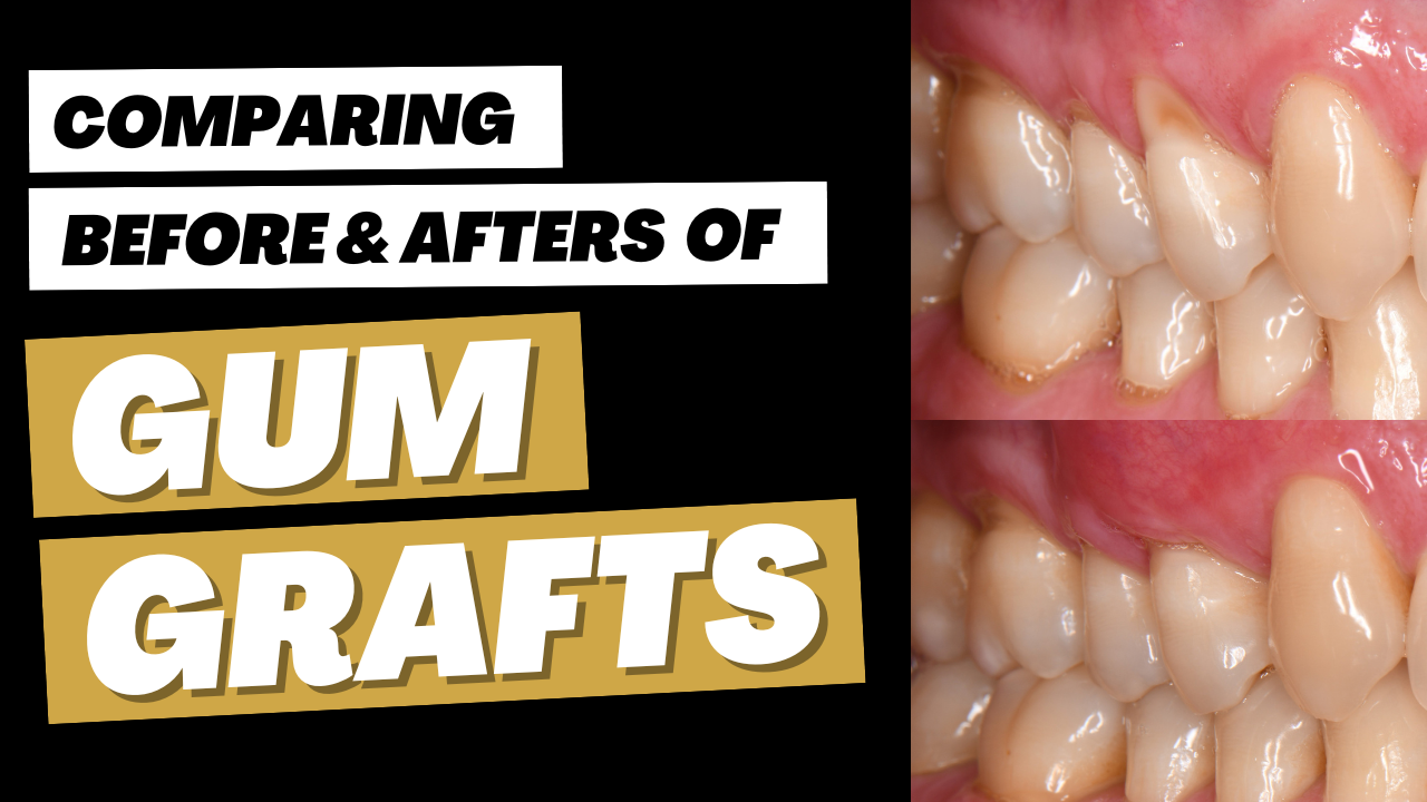 Before & After Gum Recession with Gum Graft  #periodontist  #dentist #washingtondc #dentalcare