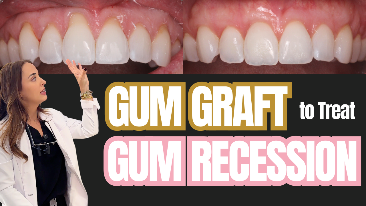 Gum Graft Fixed Gum Recession on Front Teeth